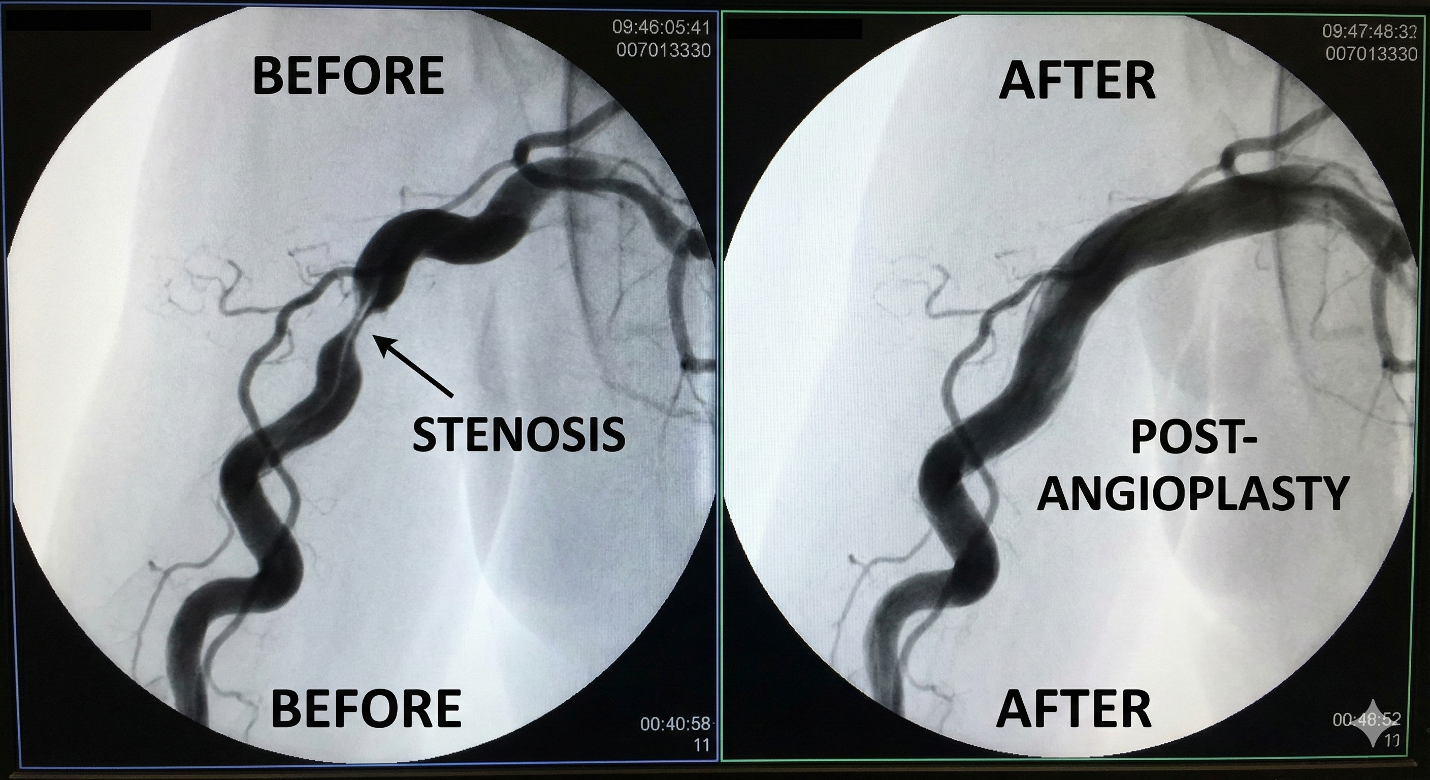 Interventional nephrology and vascular access